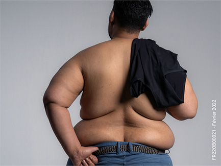Journée mondiale de l’obésité 2022 : libérer la parole, stopper les préjugés 
